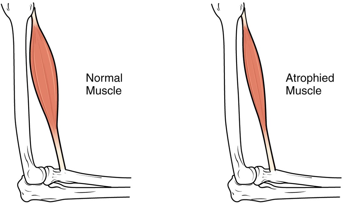 Two side-by-side drawings of the bones of the upper arm and elbow with the muscle on the front of the upper arm. On the left, labeled normal muscle, the muscle belly is full and thick. On the right, labeled atrophied muscle, the same muscle is visibly thinner along its whole length.