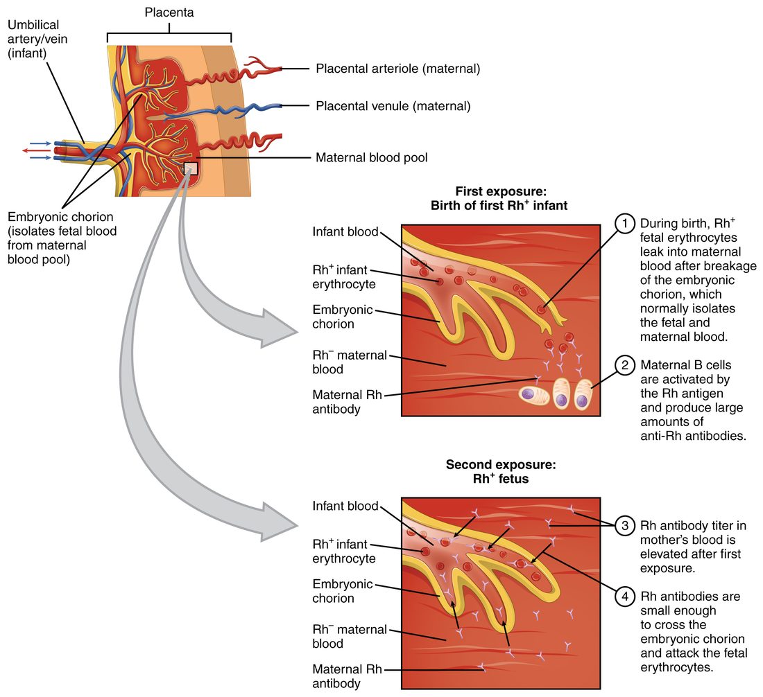 A drawing of the organ that joins mother and fetus, with a fetal blood vessel branching inside a pool of maternal blood, and two enlarged panels. The first panel shows the first birth: red cells from the baby leak across a break into the mother's blood, and her immune cells begin making Y-shaped antibodies against them. The second panel shows a later pregnancy: many antibodies are already present in the mother's blood, and they cross into the fetal vessel and attach to the fetus's red cells.
