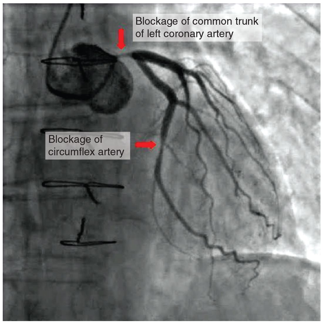 An X-ray image of the heart's arteries made visible with injected dye. Two places, one in the common trunk of the left coronary artery and one in its circumflex branch, show where atherosclerotic plaque blocks the flow of dye.