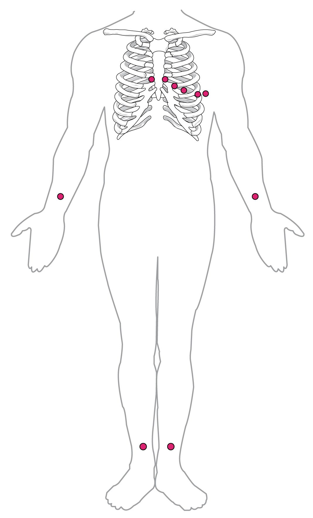Outline of a standing body seen from the front with the rib cage drawn in. Dots mark where ECG electrodes go: one on each wrist, one on each ankle, and six across the chest, two beside the sternum and four curving out to the left under the left breast area.
