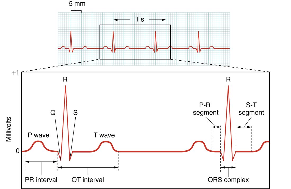 Top: a regular ECG rhythm strip on grid paper, with a bracket showing that one large square is 5 millimeters and a box spanning 1 second. The tall spikes are four large squares apart. Bottom: an enlargement of two beats, labeling the P wave, the Q, R and S points of the QRS complex, and the T wave, with brackets for the PR interval, the QT interval, the PR segment, the ST segment and the QRS complex.