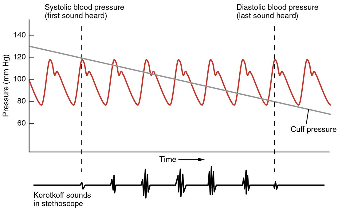 A graph of pressure against time. A wavy line shows the artery's pressure rising to about 120 and falling to about 80 with each beat. A straight line shows a cuff's pressure falling steadily from 130 to below 70. Below the graph, a trace of the sounds heard through a stethoscope shows no sound while cuff pressure is above the wave's peaks, tapping sounds while the cuff pressure is between the peaks and the troughs, and silence again once it drops below the troughs.
