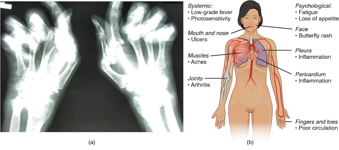 Two panels. Left: an X-ray of both hands of a person with rheumatoid arthritis; the fingers are bent sideways at the knuckles and several finger joints look narrowed and eroded. Right: a drawing of a woman's body with labels for the possible effects of lupus: a butterfly rash on the face, ulcers in the mouth and nose, inflamed pleura and pericardium, aching muscles, arthritis in the joints, poor circulation in the fingers and toes, low-grade fever and sensitivity to sunlight, and tiredness and loss of appetite.