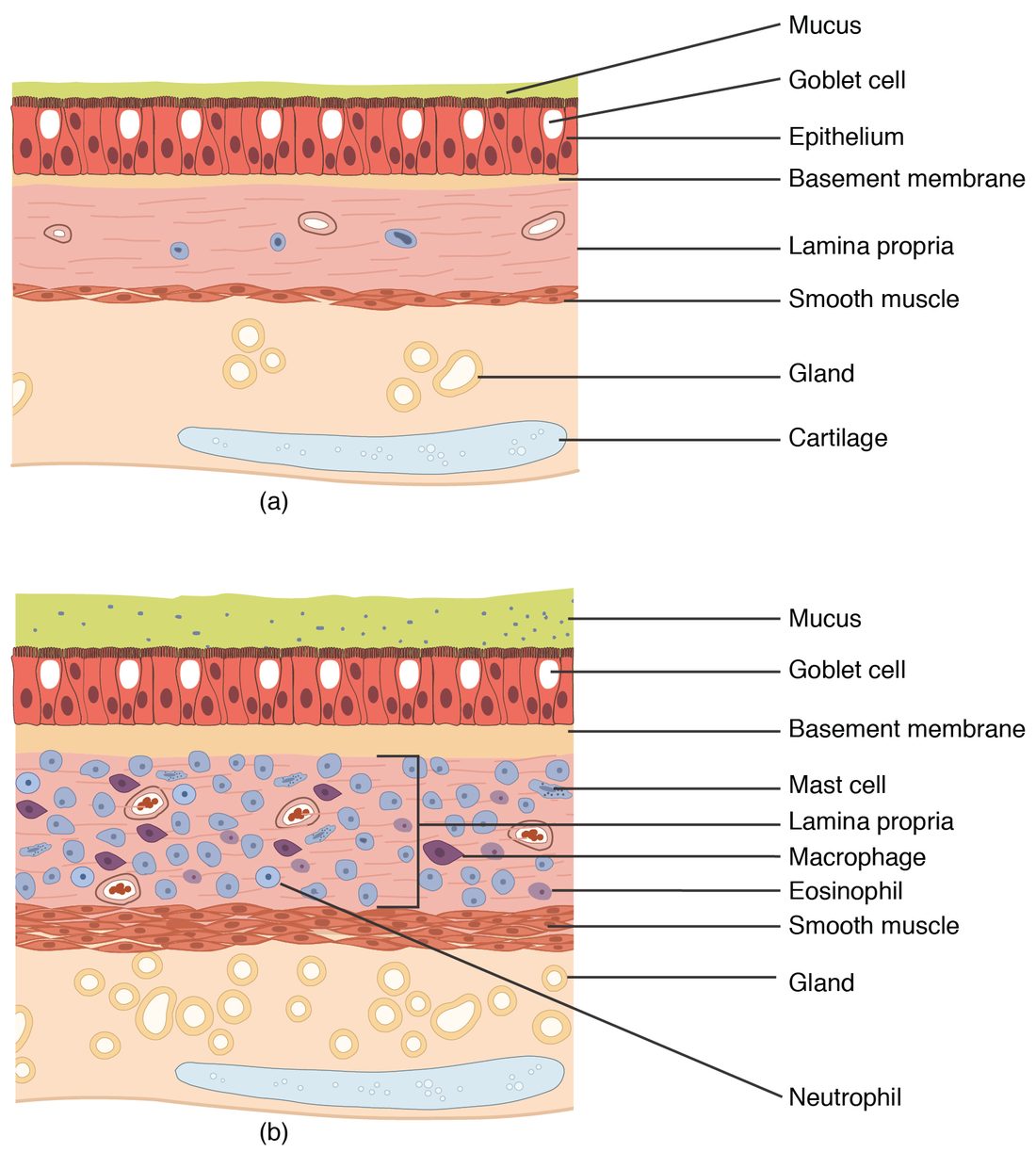 Two drawings of an airway wall in cross section. The normal wall has a thin mucus layer over the epithelium with goblet cells, a thin lamina propria with a few cells, a thin smooth muscle layer, glands and cartilage. The wall during an asthma attack has thicker, cell-studded mucus, a lamina propria crowded with mast cells, macrophages, eosinophils and neutrophils, a thicker smooth muscle layer and more glands.