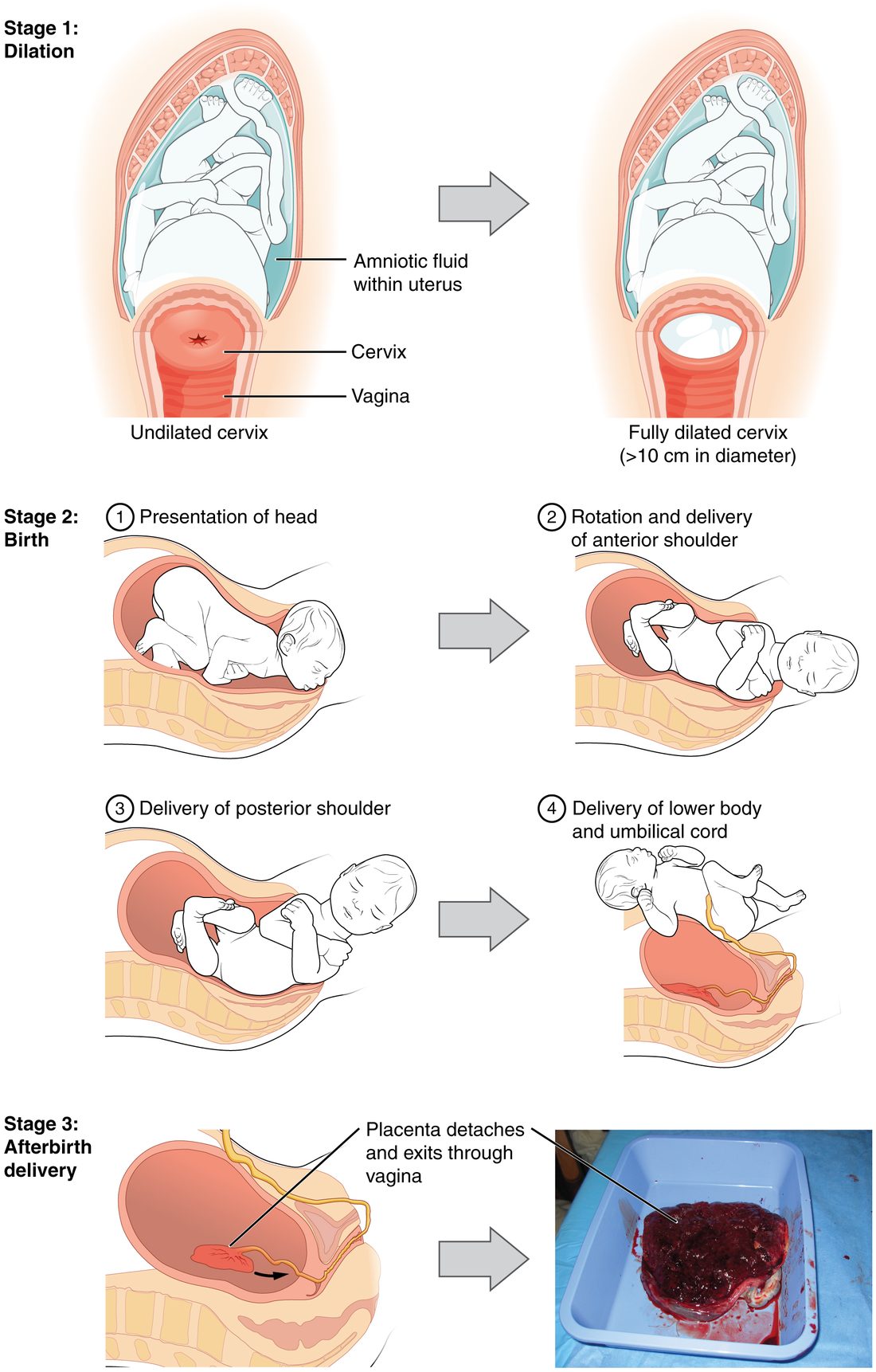 Three rows of drawings showing labor. Top row, stage 1: side views of a pregnant uterus with the fetus head-down in amniotic fluid; on the left the cervix below the head is closed and thick, and on the right it has opened fully around the head. Middle row, stage 2: four side views of the birth, with the head emerging face-down, the head turned and the front shoulder delivered, the back shoulder delivered, and finally the lower body and umbilical cord. Bottom row, stage 3: a drawing of the emptied uterus with the placenta peeling off its wall and moving toward the vagina, beside a photograph of a delivered placenta in a tray.