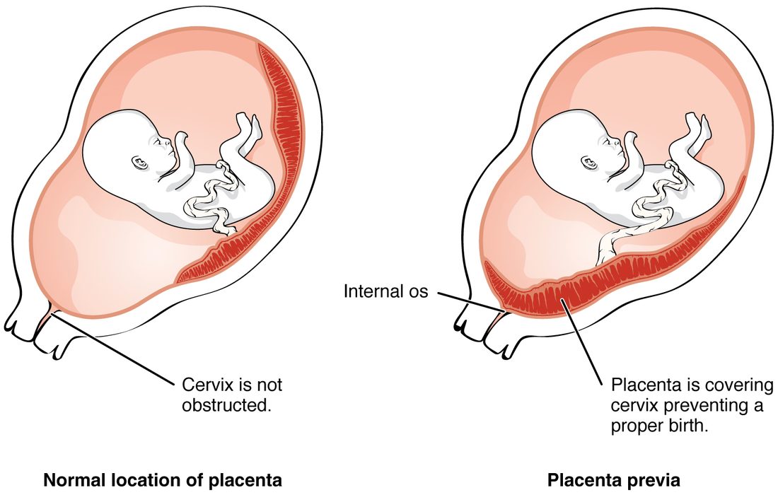 Two side views of a pregnant uterus with a fetus inside. Left: the placenta is attached high on the back wall and the opening of the cervix at the bottom is clear. Right: the placenta is attached low and lies across the internal opening of the cervix, blocking the way out.