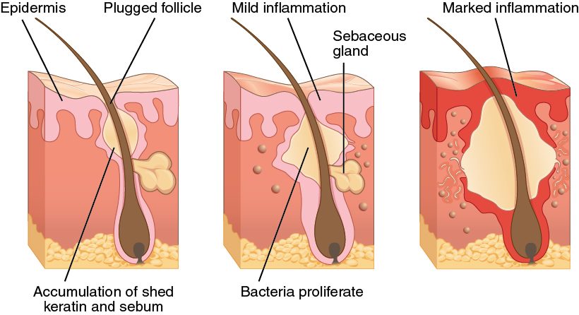 Three blocks of skin in sequence, each cut through one hair follicle with a sebaceous gland beside it. In the first, the upper follicle is swollen and plugged by a pale mass of shed cells and oily secretion. In the second, the plug is larger, bacteria are shown multiplying, and the tissue around it is pink with mild inflammation. In the third, the swollen follicle has burst into the surrounding dermis, which is bright red with marked inflammation.