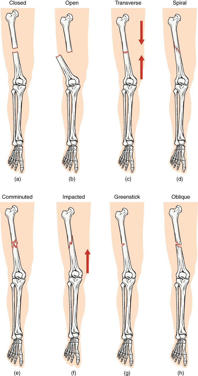 Eight drawings of the leg bones inside the outline of a leg, each showing a different break in the thigh bone: a clean break straight across with the pieces separated, a break with the lower piece pushed out through the skin, a crack straight across with arrows pushing from both ends, a break winding around the shaft, a break shattered into several pieces, a jagged break with the ends pushed together by an upward arrow, a crack only partway across the bone, and a single break at an angle.