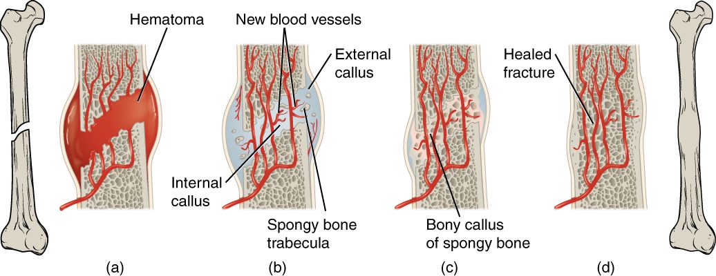 A broken thigh bone at far left and a healed one at far right, with four magnified stages of healing between them. (a) A large red mass of clotted blood fills and surrounds the break. (b) New blood vessels grow across the gap, pale blue tissue forms a collar around the outside and fills the space between the broken ends, and a few new bone struts appear. (c) Spongy bone now bridges the gap, with some of the outer collar left. (d) The break is healed, with a slight bulge where it was.