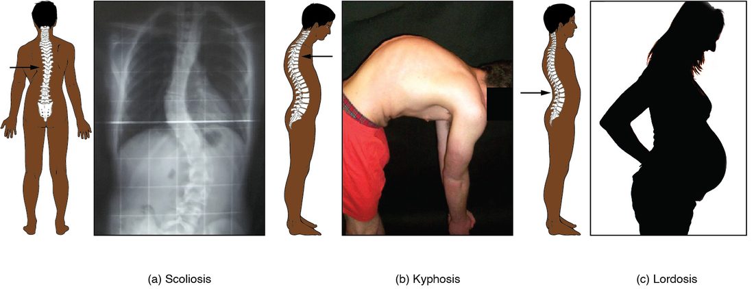 Three pairs of images of abnormal backbone curves. The first pair, a back-view drawing and an X-ray, shows the backbone bent sideways into an S. The second pair shows a side view with an exaggerated rounded upper back and a photo of a man bending forward with a hunched upper back. The third shows an exaggerated inward curve of the lower back and a side silhouette of a pregnant woman.