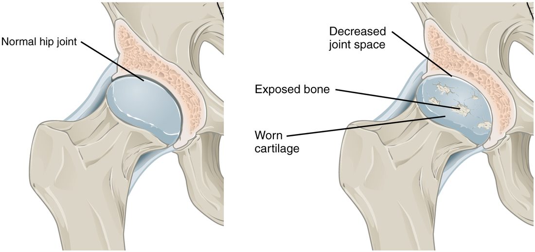 Two drawings of the hip joint side by side. On the left, the ball of the thigh bone is covered with smooth, even cartilage and sits in its socket with a clear gap. On the right, the cartilage is thin and cracked, patches of bare bone show through, and the gap between the bones is narrower.
