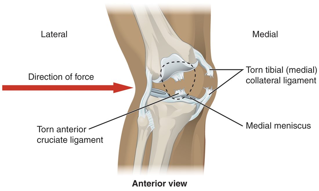 A front view of a right knee struck from the outer side, shown by a large red arrow. Three injuries are shown: the ligament on the inner side of the knee is torn, the inner C-shaped cartilage pad is damaged, and one of the crossing ligaments inside the knee is torn.